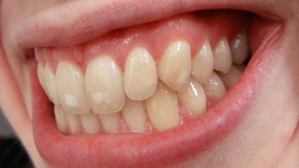 Drinking coffee with braces can leave stains on your teeth.
