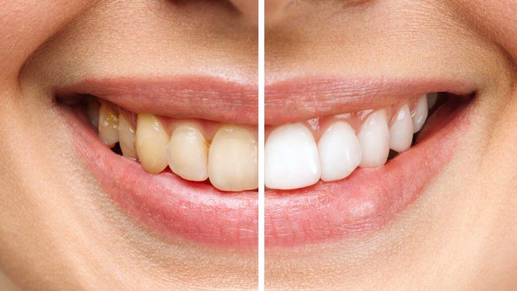 After how long can I drink coffee with Teeth whitening strips.